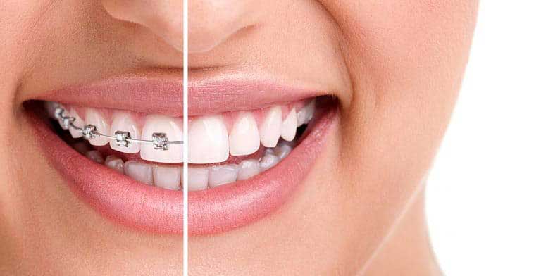 women with braces