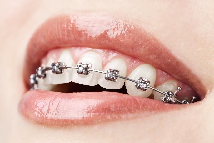 Metal Braces