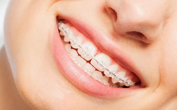 Porcelain / Clear Braces